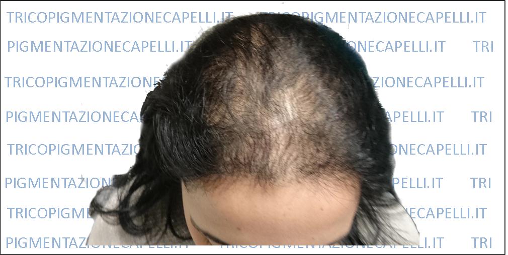 Tricopigmentazione Donna Ripigmentazione Capelli Come Infoltire Infoltimento Capelli Rimedio Permanente Caduta Perdita Prima Vicenza Padova Milano Brescia Veneto Lombardia Treviso Venezia Verona Belluno Rovigo Udine Pordenone Tricopigmentazione