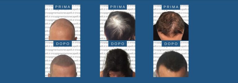 Tricopigmentazione-costi-prezzi-effetto-rasato-densita-infoltimento-non-chirurgico-come-infoltire-capelli-vicenza-padova-milano-brescia-veneto-lombardia-treviso-venezia-verona-1