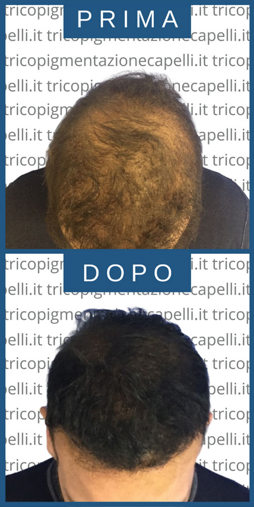 tricopigmentazione-effetto-densita-infoltimento-capelli-lunghi-non-chirurgico-uomo-vicenza-padova-milano-brescia-trento-8