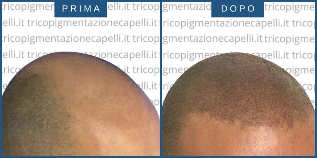 Tricopigmentazione-permanente-effetto-rasato-prima-dopo-vicenza-padova-milano-verona-brescia-trento-piacenza-2
