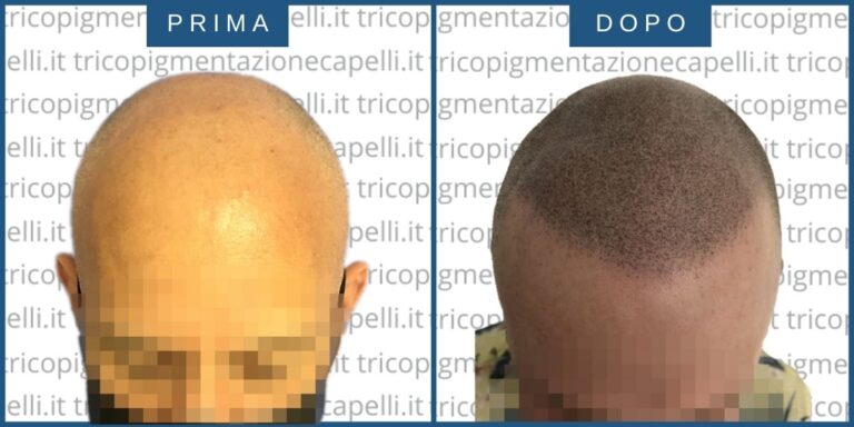 Tricopigmentazione-permanente-effetto-rasato-prima-dopo-vicenza-padova-milano-verona-brescia-trento-piacenza-3