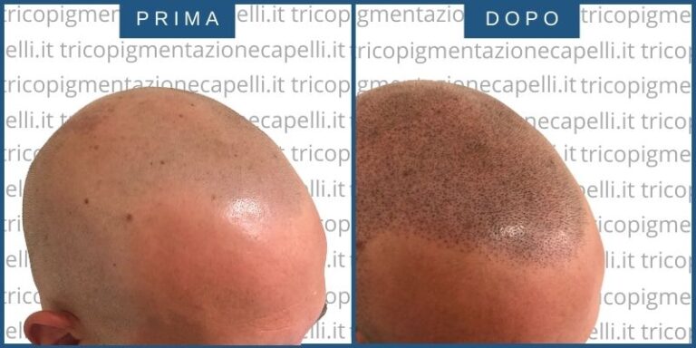 Tricopigmentazione-permanente-effetto-rasato-prima-dopo-vicenza-padova-milano-verona-brescia-trento-piacenza-5