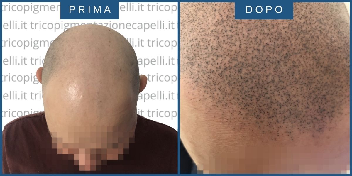 Tricopigmentazione-permanente-effetto-rasato-prima-dopo-vicenza-padova-milano-verona-brescia-trento-piacenza-7