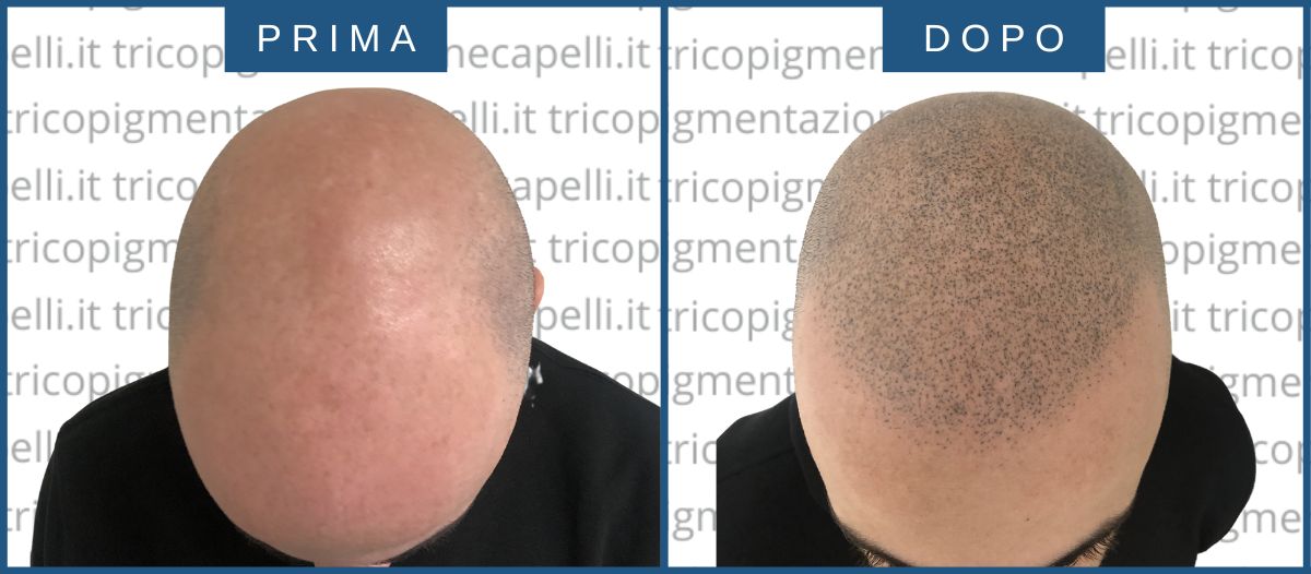 Tricopigmentazione permanente effetto rasato prima e dopo vicenza padova brescia treviso verona milano trento venezia chiasso 30-1-23