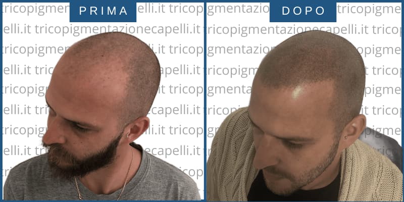 Tricopigmentazione-prima-dopo-effetto-rasato-treviso-conegliano-opinione-riccardo-cremonese